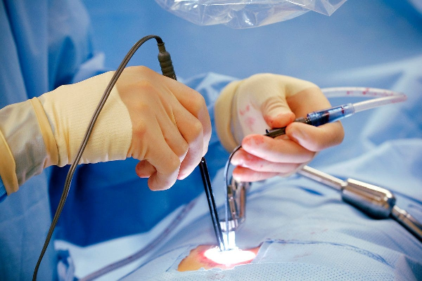 Surgical Procedure for Piles