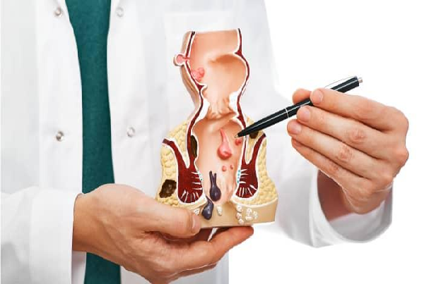 Surgical Procedure for Fissure