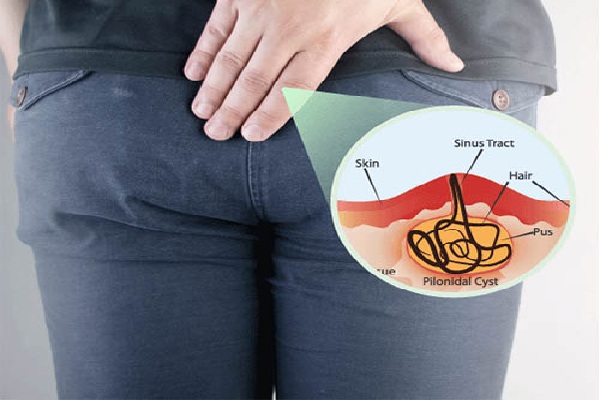 Surgical Procedure for Pilonidal Sinus