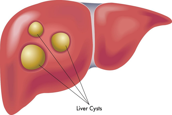 Liver Cysts