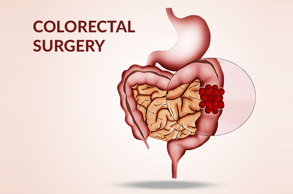 Colorectal Surgeries