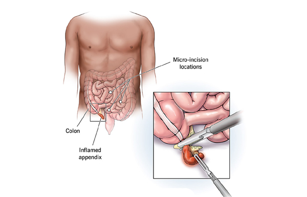 Laparoscopic Surgery for Appendicitis